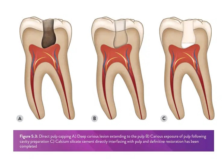 Direct Pulp Capping